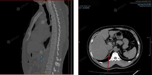 Lipoma (u mỡ) chân hoành là gì? Khi phát hiện lipoma chân hoành cần làm gì tiếp theo?